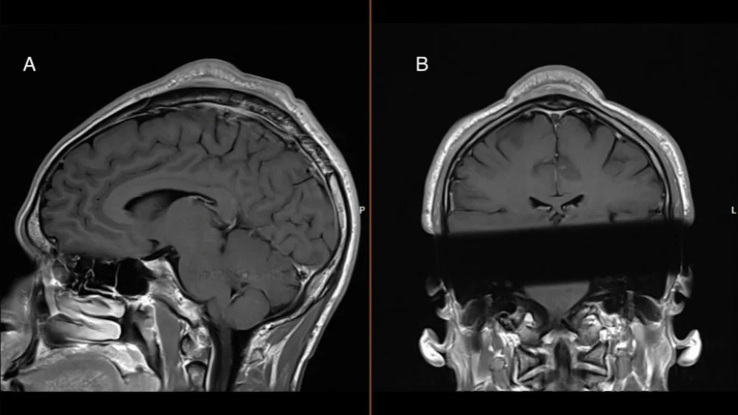 Una resonancia magnética muestra el tumor que los médicos creen que se desarrolló debido a los repetidos giros de cabeza. Informes de casos de BMJ 2024